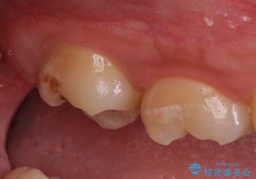 歯の高さを出すための親知らず抜歯と歯肉切除の治療前