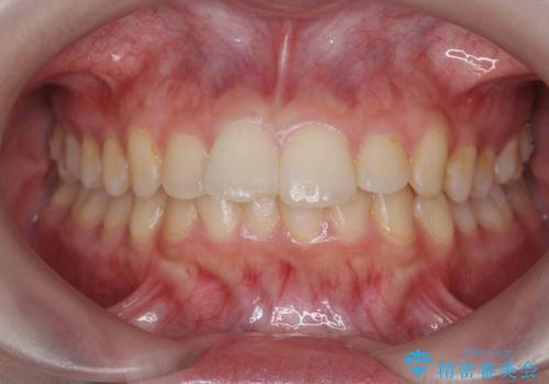 半年で行えるマウスピース矯正の症例 治療前