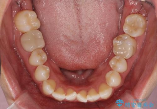 [ インビザライン ]  前歯のガタつきをマウスピース矯正で改善の治療前
