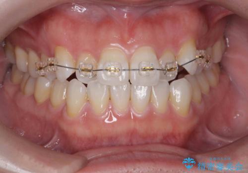 受け口傾向のマウスピース矯正 (ワイヤー治療を併用して)の治療中