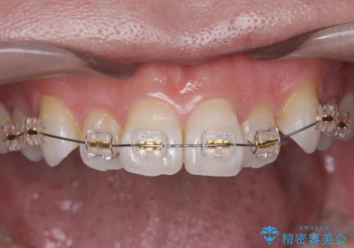 受け口傾向のマウスピース矯正 (ワイヤー治療を併用して)の治療中