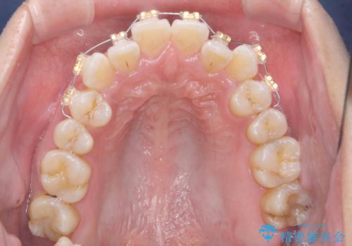 受け口傾向のマウスピース矯正 (ワイヤー治療を併用して)の治療中