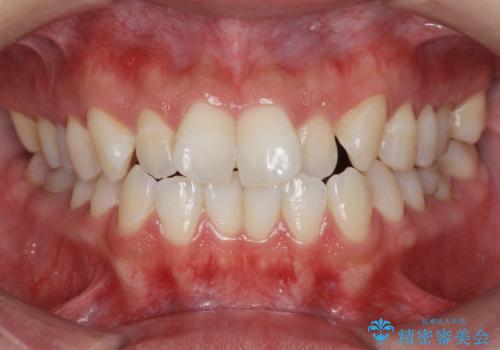 [ インビザライン ]  前歯のガタつきをマウスピース矯正で改善の症例 治療前