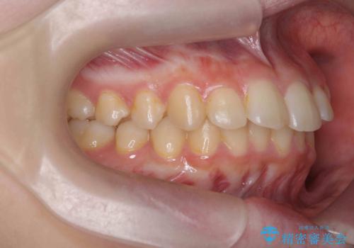 半年で行えるマウスピース矯正の治療前