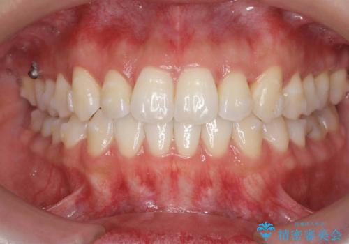 [ インビザライン ]  前歯のガタつきをマウスピース矯正で改善の治療中