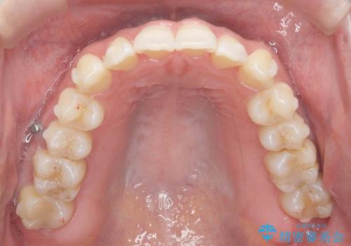 [ インビザライン ]  前歯のガタつきをマウスピース矯正で改善の治療中