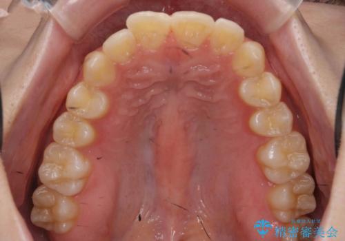 半年で行えるマウスピース矯正の治療前