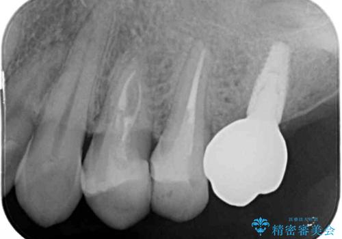 根管治療を行ったままの奥歯 オールセラミッククラウンによる補綴治療の治療前