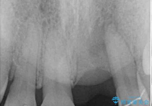 中途半端な矯正治療と前歯の欠損 再矯正とオールセラミッククラウンによる補綴治療の治療前