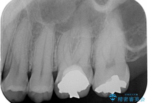フルジルコニアクラウンの治療前