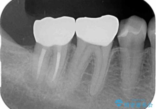 [ フルジルコニアクラウン治療 ]    銀歯を外したいの治療後