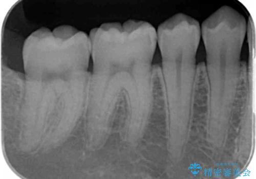 矯正後の虫歯治療 セラミックインレーでの治療の治療前