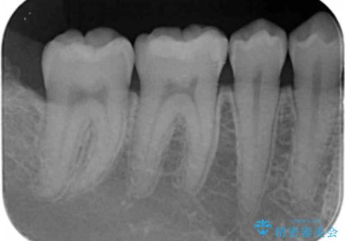 矯正後の虫歯治療 セラミックインレーでの治療の治療後
