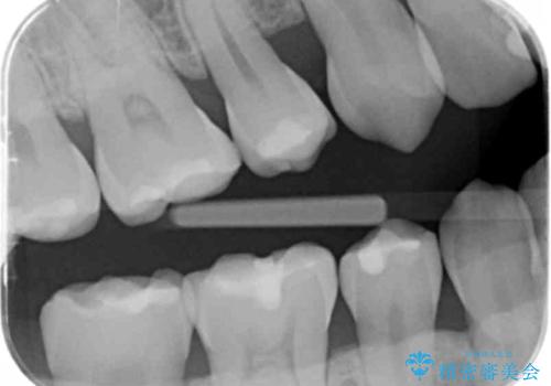 奥歯が欠けた セラミックインレーでの修復後、ナイトガード装着の治療前