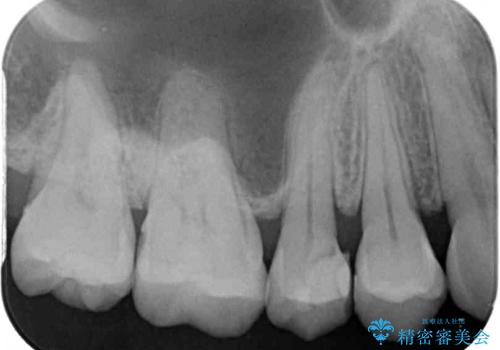 奥歯に物が挟まる　セラミックインレーによる虫歯治療の治療前