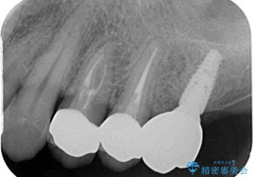 根管治療を行ったままの奥歯 オールセラミッククラウンによる補綴治療の治療後