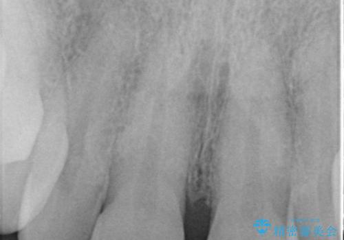 前歯の隙間をオールセラミッククラウンで自然にの治療前