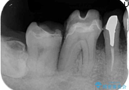 歯周病により抜去した歯のインプラント治療の治療前