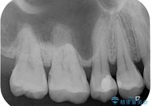 奥歯に物が挟まる　セラミックインレーによる虫歯治療の治療後