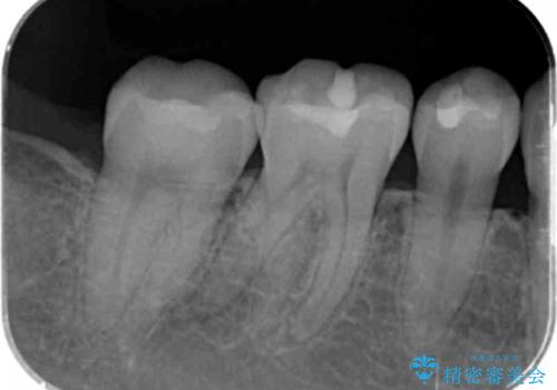 奥歯が欠けた セラミックインレーでの修復後、ナイトガード装着の治療後