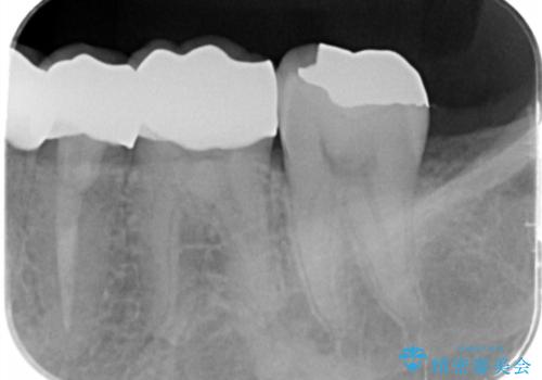 ゴールドクラウンの治療前