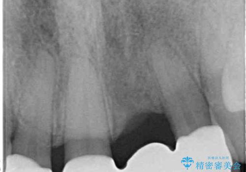中途半端な矯正治療と前歯の欠損 再矯正とオールセラミッククラウンによる補綴治療の治療後