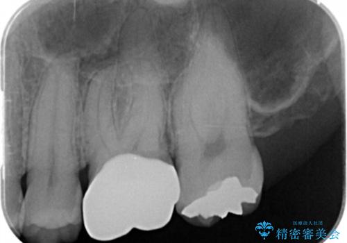 フルジルコニアクラウンの治療後