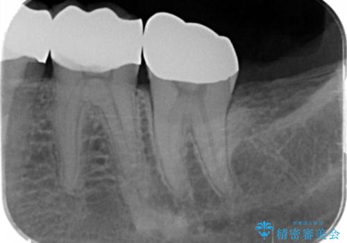 ゴールドクラウンの治療後
