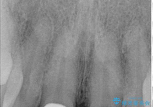 前歯の隙間をオールセラミッククラウンで自然にの治療後