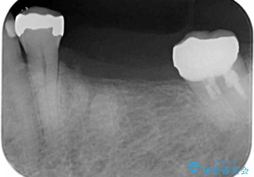 下顎骨隆起を用いた骨造成・インプラント補綴の治療前