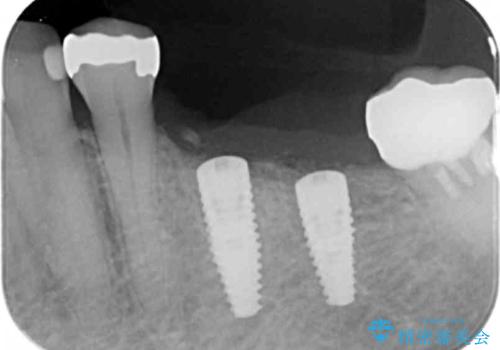 下顎骨隆起を用いた骨造成・インプラント補綴の治療中