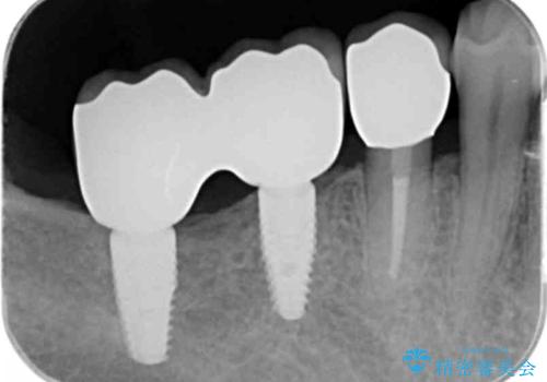 歯周病により抜去した歯のインプラント治療の治療後