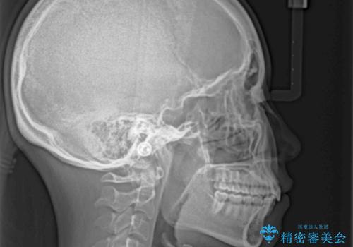 上の出っ歯を治したい インビザラインによる矯正治療の治療後