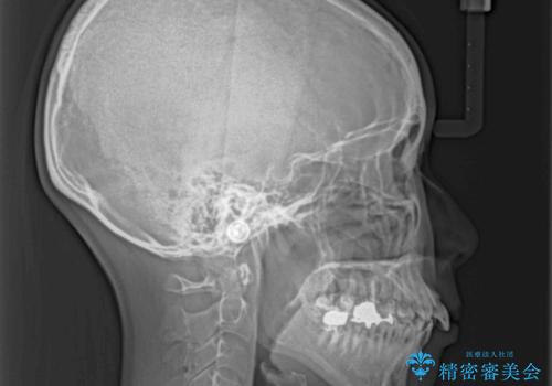 V字型に飛び出した前歯 ワイヤー装置での抜歯矯正の治療前