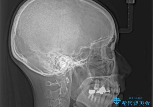 V字型に飛び出した前歯 ワイヤー装置での抜歯矯正の治療後