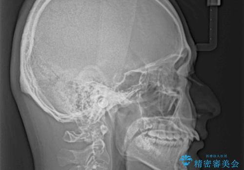 【モニター】飛び出した上の前歯 ワイヤー装置を併用してインビザラインできれいにの治療前