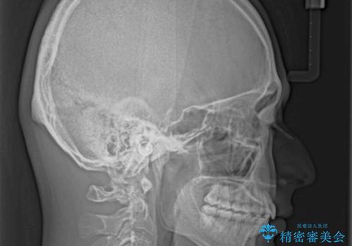 【モニター】飛び出した上の前歯 ワイヤー装置を併用してインビザラインできれいにの治療後