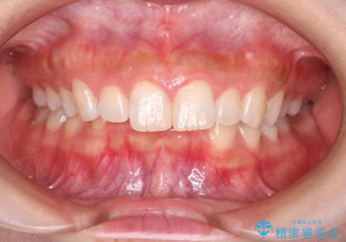 上の出っ歯を治したい インビザラインによる矯正治療の症例 治療前