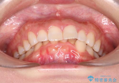 上の出っ歯を治したい インビザラインによる矯正治療の治療前