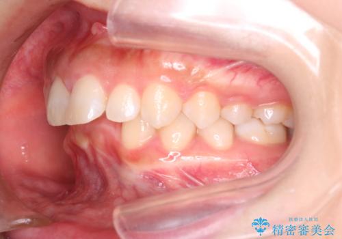 上の出っ歯を治したい インビザラインによる矯正治療の治療前