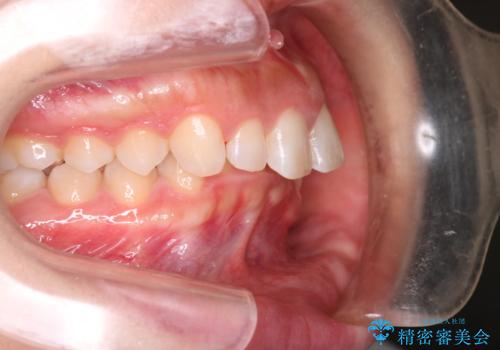 上の出っ歯を治したい　インビザラインによる矯正治療の治療前