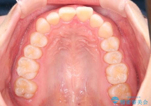 上の出っ歯を治したい　インビザラインによる矯正治療の治療前
