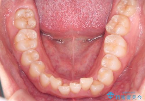 上の出っ歯を治したい インビザラインによる矯正治療の治療前