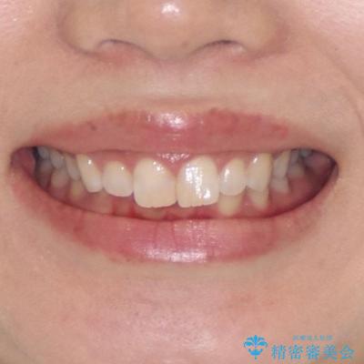 上の出っ歯を治したい インビザラインによる矯正治療の治療前(顔貌)