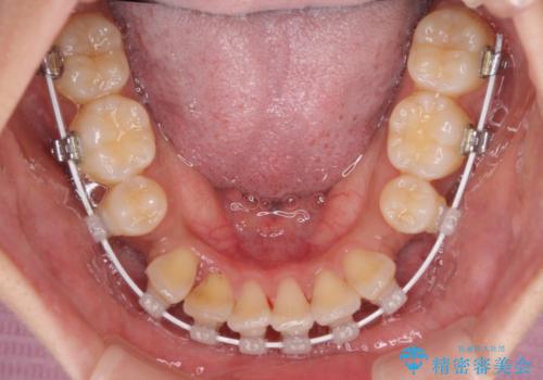 目立たないハーフリンガル矯正 抜歯矯正で口元の突出感を改善の治療中
