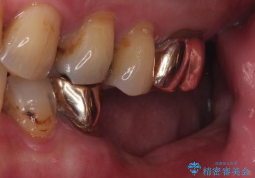 【インプラント】銀歯が取れて歯ごと折れたの治療前