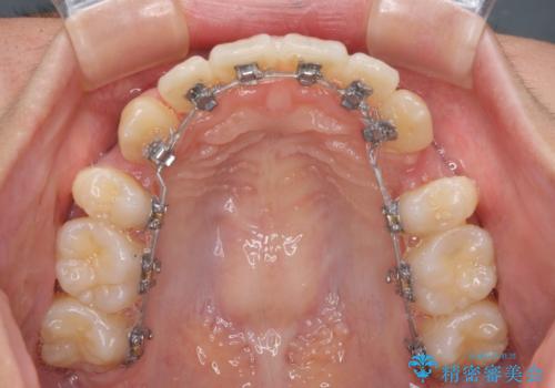 目立たないハーフリンガル矯正 抜歯矯正で口元の突出感を改善の治療中