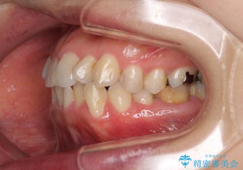 【モニター】上下前歯の叢生を解消　インビザライン矯正治療の治療前