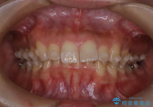 上の出っ歯を治したい インビザラインによる矯正治療の治療中