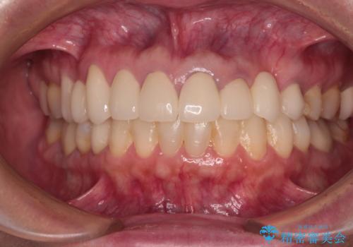 欠損やむし歯の歯をきれいなセラミックに　全顎虫歯治療の治療後